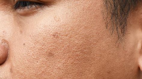 Different Types Of Acne, Hypertrophic Scars, Get Rid Of Acne, Rid Of Acne, Types Of Acne, Skin Tissue, Laser Therapy, Layers Of Skin, How To Get Rid Of Acne