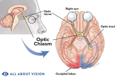 Optic Chiasm - All About Vision Corneal Abrasion, Glasses For Round Faces, Eye Anatomy, Eye Twitching, Optic Nerve, Nerve Fiber, Eye Parts, Soft Contact Lenses, Eye Safety