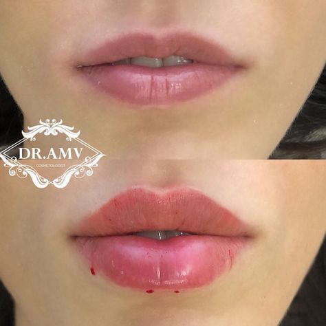 Lip Fillers Juvederm, Dermal Fillers Lips, Lips Fillers, Lips Shape, Rhinoplasty Nose Jobs, Lips Inspiration, Face Fillers, Botox Lips, Facial Fillers