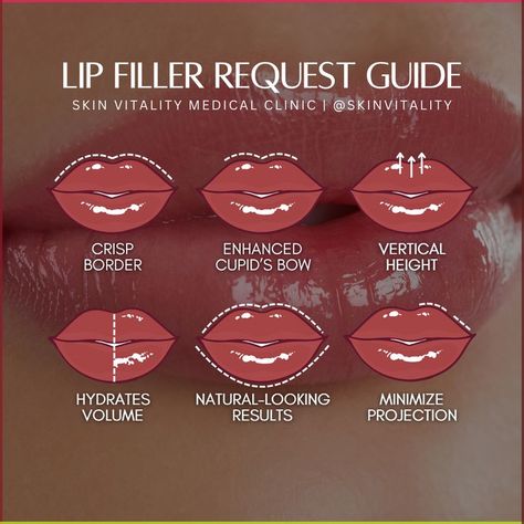 Pillow Lips Filler, Full Syringe Lip Filler Before And After, Diy Lip Filler, Asian Lip Filler, Lip Shapes Filler, Lip Filler Natural Look, Lip Filler Healing Stages, Lip Flip Vs Filler, Natural Lip Fillers 1ml