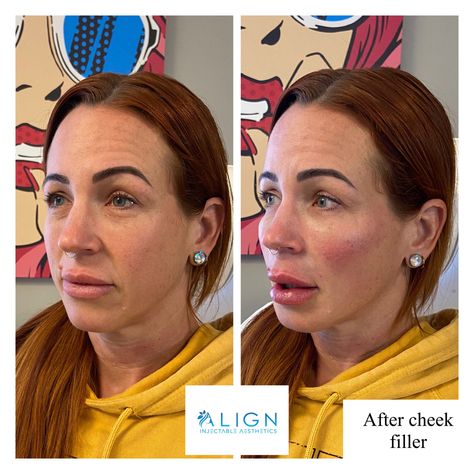 Before and after 2 syringes of cheek filler. 💉 📱918-407-9058📱 Cheek Filler Before And After, Cheek Fillers Before And After Face, Kpop Plastic Surgery, Jaw Reduction Surgery, V Line Surgery, Plastic Surgery Fail, Korean Plastic Surgery, Plastic Surgery Gone Wrong, Face Surgery