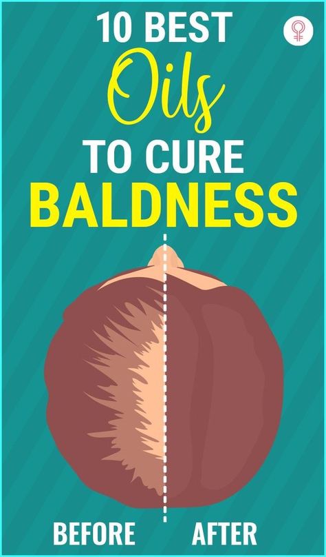 Bonus: Avoid using too many hair products that contain phthalates. #haircare #hair #hairfall Expensive Hair, Regrow Hair Naturally, Female Pattern Baldness, Liver Diet, Brown Spots On Face, Hair Growth Supplement, Home Remedies For Hair, Regrow Hair, Baking Soda Shampoo