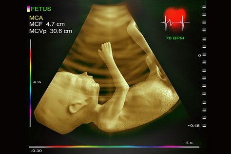 A fetal echo or fetal echocardiography ensures a thorough examination which includes a scan of your baby’s heart. Find here its purpose, procedures & risks. Echo Cardiography, Fetal Echocardiography, Atrial Septal Defect, Pericardial Effusion, Heart Structure, 4d Ultrasound, Pregnancy Ultrasound, Pregnancy Ideas, Ultrasound Technician