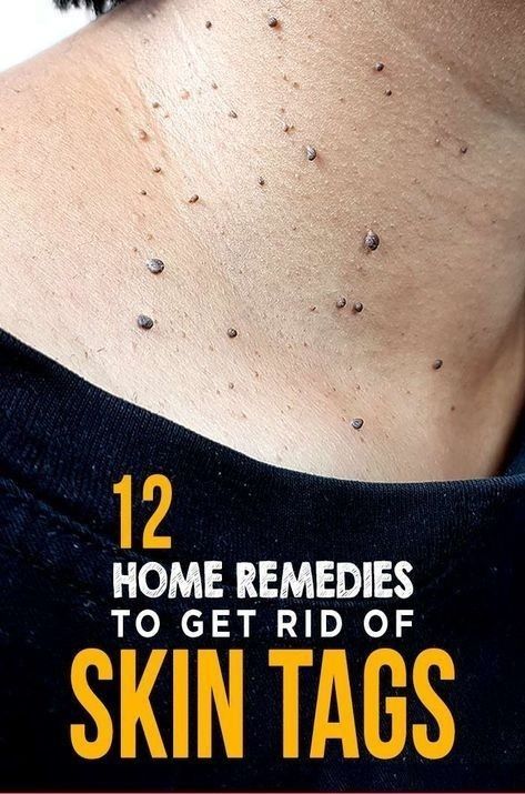 12 Home Remedies to Get Rid of Skin Tags : Little research has looked into whether apple cider vinegar can remove skin tags. People who try this often soak a cotton ball in the vinegar and affix it to ... | How to get rid of skin tags | Home Remedies for Skin Tag Removal | remove skin tags | #homeremediesforskintags #skintags #homeremedies #removeskintags #homedoctor #healthtips Remedies For Sickness, Juice For Skin, Remove Skin Tags Naturally, Body Skin Care Products, Home Remedies For Warts, Natural Remedies For Cough, Remove Skin Tags, Oregano Essential Oil, Chesty Cough