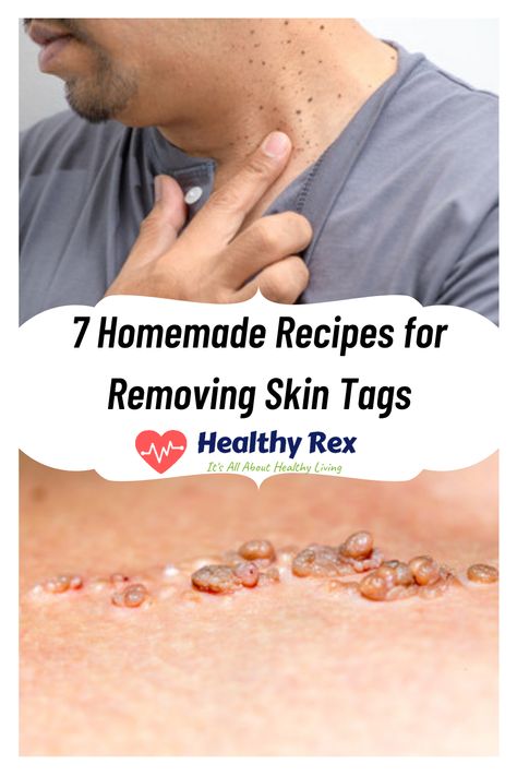 Now that you know instant ways to remove skin tags, it’s time to learn about some useful homemade recipes that remove skin tags overnight. #Skincare #SkincareTips #SkinTag #SkinMoles #HomemadeRecipes Remove Skin Tags, Remove Skin Tags Naturally, Skin Moles, Cold Medicine, Skin Natural Remedies, Skin Tags, Cold Sores Remedies, Natural Health Care, Natural Sleep Remedies