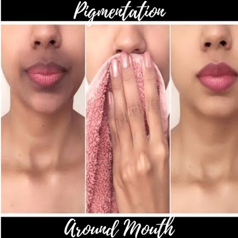 https://www.glossypolish.com/causes-remedies-skin-pigmentation-around-mouth/ , #darkskinaroundthemouth #SkinPigmentation Hyperpigmentation Around Mouth, Lip Hyperpigmentation, Dark Skin Around Mouth, Pigmentation Remedy, Remedies For Dark Lips, Get Rid Of Hyperpigmentation, Removing Hyperpigmentation, Remedies For Skin, Treating Hyperpigmentation