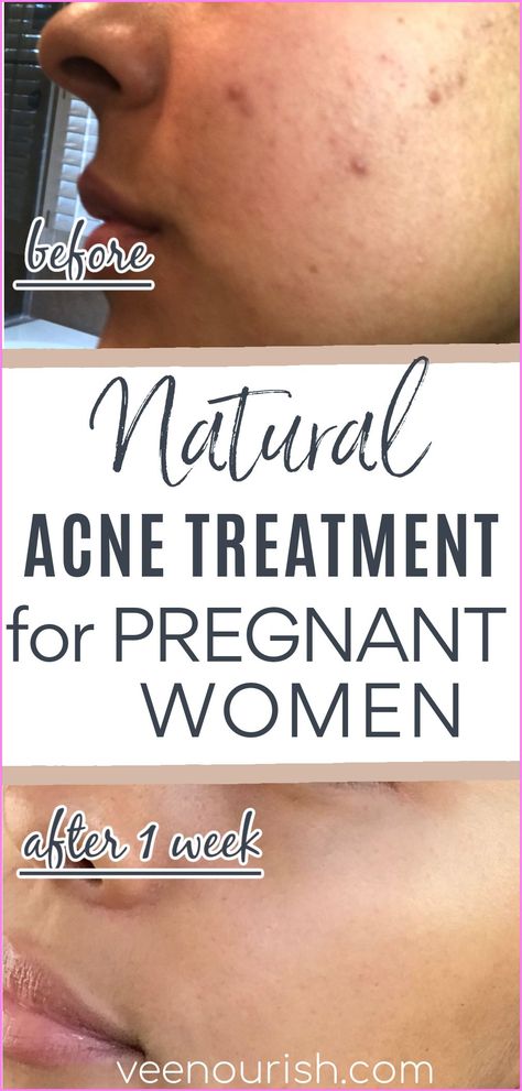 Body Acne Remedies, Pregnancy Safe Skin Care, Pregnancy Remedies, Pregnancy Acne, Hormonal Acne Remedies, Acne Products, Pregnancy Skincare, Face Care Tips, Diy Acne