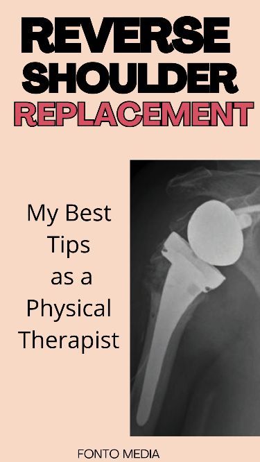 Exercises after Reverse Shoulder Replacement surgery: to do and not to do! For your recovery, by a physical therapist! Shoulder Replacement Exercises, Shoulder Exercises Physical Therapy, Reverse Shoulder Replacement, Shoulder Surgery Recovery, Shoulder Replacement Surgery, Physical Therapy Exercises, Shoulder Surgery, Rotator Cuff, Surgery Recovery