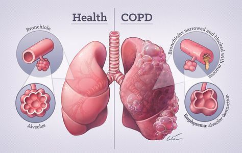 Portfolio - Medical Illustration by Dr Ciléin Kearns (Artibiotics) — artibiotics Home Remedies For Bronchitis, Hyperbaric Oxygen Therapy, Pulmonology, Chronic Obstructive Pulmonary Disease, Nursing School Notes, Pulmonary Disease, Lung Disease, Medical Art, Medical Knowledge