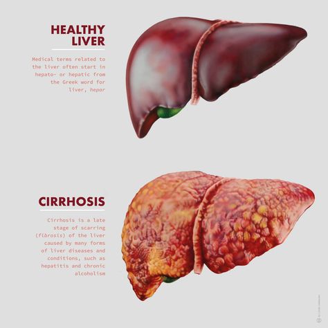 Medical illustration depicting the differences between a healthy liver and one with cirrhosis. Expertly illustrated by Linda Lubbersen, founder of #StudioLindalu. Explore more work by Studio Lindalu on the Medical Illustration & Animation Sourcebook online site. #scienceillustration #scienceart #scienceartist #scientificillustration #scientificvisualization #science #medicine #medicalillustration #illustration #anatomy #pathology #liver #cirrhosis #research #organs #health #disease #editorial Medical Graphic Design, Liver Drawing, Liver Illustration, Organs Illustration, Human Liver Anatomy, Liver Organ, Human Body Science Projects, Illustration Anatomy, Liver Anatomy