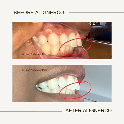 2024 is the year I fixed my overbite 🥹. I had been wanting to fix it for years but I didn’t want to commit to 2+ years of metal braces, nor the usual $5k for the popular invisible aligner company. I can confidently show my toothy-smile again, and it was the quickest and most affordable option! All thanks to @alignerco_us !!! DM me for a discount code of $150-200 off! #alignerco #alignercous Toothy Smile, Metal Braces, Braces, Discount Code, Fix It, Dm Me, The Year, I Can, Coding