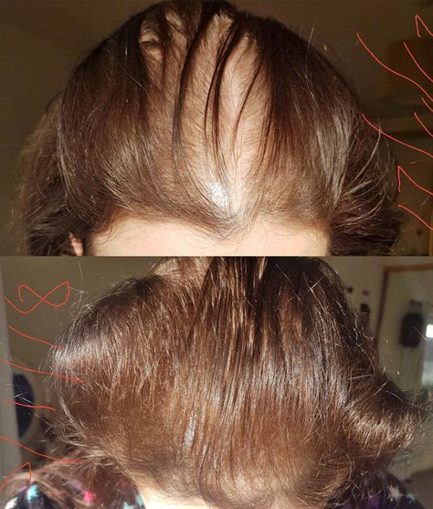 This Drugstore Product Regrew a Woman's Thinning Hair in 6 Weeks and the Pics Are Unreal Thinning Hairline Women, Thining Hair Remedy, Thinning Hair Remedies Women, Thinning Hair Women, Thining Hair, Thinning Hair Remedies, Hair Growth Formula, Natural Hair Removal, Natural Hair Growth Tips