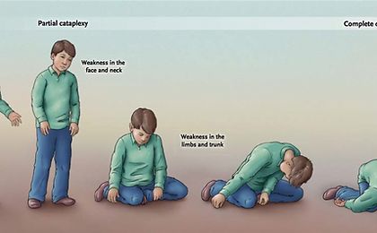 Discover the enigmatic phenomenon of cataplexy, a sudden loss of muscle tone triggered by emotions, and its impact on daily life. - #CataplecticEpisodes #Emotion-InducedParalysis #EmotionalFactorsinCataplexy #EmotionalInducedParalysis #EmotionalParalysisSyndrome #EmotionalTriggeredWeakness #LossofMuscleControlbyEmotions #MuscleCollapseduetoEmotions #MuscleToneLossbyEmotions... Muscle Weakness, Muscle Tone, Daily Life, Health