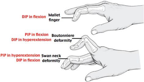 Mallet Boutonniere Swan Neck Orthopedic Nursing, Nursing Cheat Sheet, Hand Anatomy, Nursing Cheat, Nursing Humor, Skeletal System, Musculoskeletal System, Swan Neck, Hand Therapy