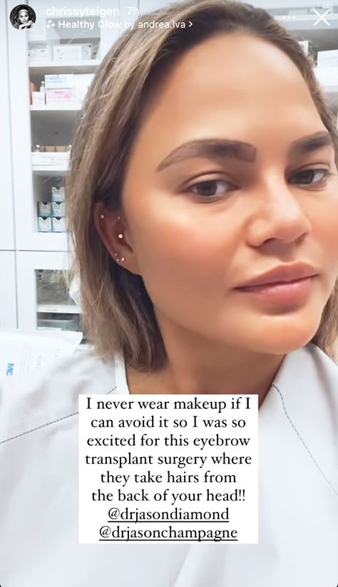 Chrissy Teigen Debuts New Eyebrows Following Transplant, Warns Teens to 'Not Pluck Them All Off' Brow Transplant, Eyebrow Transplant Before After, Microbladed Eyebrows, Chrissy Teigen Makeup, Natural Microblading Eyebrows, Eyebrow Hair Transplant, Chrissy Teigen Hair, Chrissy Teigen Instagram, Instagram Eyebrows