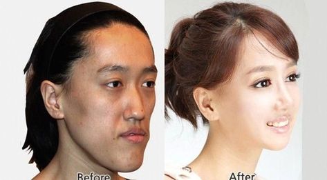 Korean Plastic Surgery – Before and After 14.There is hope for everyone just d - #14There #Hope #Korean #Plastic #Surgery Asian Makeup Before And After, Face Plastic Surgery, Botched Plastic Surgery, Skincare Routine 20s, Avocado Skincare, Beauty Diy Skincare, Korean Plastic Surgery, Korean Cosmetic, Facial Contouring