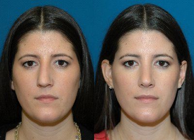 Nose Rhinoplasty, Hooked Nose, Crooked Nose, Rhinoplasty Surgery, Nose Surgery, Nose Job, Plastic Surgeon, Cosmetic Surgery, Plastic Surgery