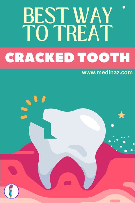 Best Way to Treat Cracked Tooth (Fractured Tooth) - A detailed guide Chipped Tooth Aesthetic, Baby Bottle Tooth Decay, Cracked Tooth, Chipped Tooth, Tooth Filling, Tooth Decay Remedies, Tooth Repair, Molar Tooth, Tooth Pain