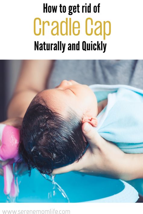 Natural Cradle Cap Remedy, Cradle Cap Remedies For Adults, How To Get Rid Of Cradle Cap, Toddler Cradle Cap, Baby Dandruff, Cradle Cap Remedies, Baby Cradle Cap, Holistic Motherhood, Baby Remedies