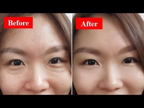 How To Get Rid Of Eye Bags Overnight, Undereye Bags Remedy, Eye Bag Remedies, Overnight Remedies, Under Eye Hollows, Baggy Eyes, Reduce Eye Bags, Remove Eye Bags, Pimples Overnight