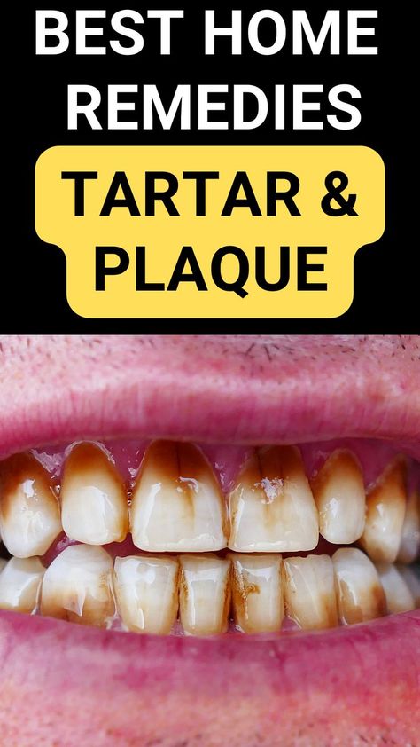 8 Natural Ways to Remove Tartar from Your Teeth#plaqueremoval #plaqueremovalathome #tartarremoval #gettingridoftartaronteeth #tartarandplaqueremovalhomeremedies Plaque Removal At Home, Tartar Removal, Tooth Decay Remedies, Dental Cavities, Tooth Sensitivity, Oral Care Routine, Gum Care, Receding Gums, Natural Teeth