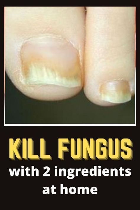 Fungal Nail Infections Toenail Fungal Infection, Nail Remedies, Fingernail Fungus, Toenail Fungus Remedies, Nail Problems, Nail Fungus Remedy, Nail Infection, Fungal Nail, Nails Today