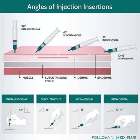 𝐌𝐞𝐝 𝐏𝐥𝐮𝐬 | 𝐀𝐈𝐈𝐌𝐒 | 𝐄𝐒𝐈𝐂 | on Instagram: “Angles of injection insertion... Follow: @_med_plus 👉 Tags like ❤️, save, comments & share, it with your classmates 👬👭. Follow…” Im Injection Sites, Medical Assistant Certification, Nursing School Clinicals, Nurse Skills, Medical Assistant Student, Veterinary Surgery, Nurse Study Notes, Medication Administration, Nursing Student Tips