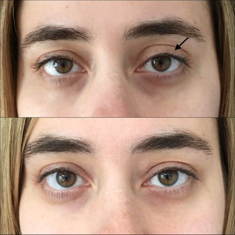 Patient 54031171 | Eyelid Filler Before & After Photos | Flora Levin MD Eyelid Filler, Big Eyelids, Eye Filler, Under Eye Fillers, Botox Cosmetic, Cheek Fillers, Tears In Eyes, How To Get Bigger, Upper Eyelid