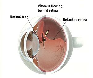 Detached and torn retina: A retinal detachment occurs when the retina is pulled away from its normal position. The retina does not work when it is detached. Vision is blurred, just as a photographic image would be blurry if the film were loose inside the camera. Torn Retina, Vitrectomy Surgery, Opthalmic Technician, Thyroid Surgery, Eye Facts, Eye Sight Improvement, Eyes Problems, Human Eye, Medical Information