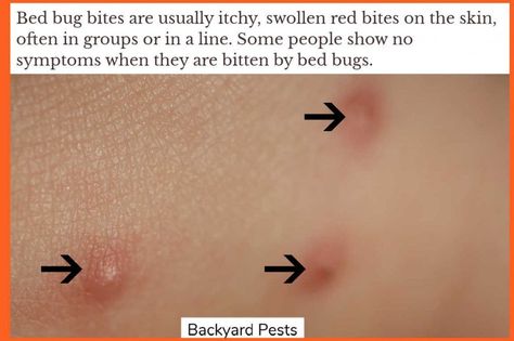 Bed bug bites are one of the signs of bed bugs #bedbugs #bedbugsigns #bedbugbites #backyardpests Bed Bugs Bites Pictures, Infected Bug Bite, Bed Bug Bites Remedies, Bed Bugs Bites, Bed Bug Bites Pictures, Types Of Bug Bites, Bed Bugs Essential Oils, Bed Bug Remedies, Bed Bugs Pictures