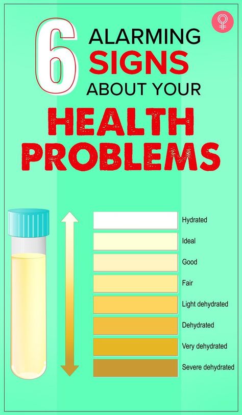 6 Alarming Signs About Your Health Problems: We need to understand and identify the signs that our body gives to us before we get caught in the unpleasant circle of critical life-threatening diseases. Here’s a list of a few telltale signs that our body gives in order to warn us of upcoming health problems. #health #healthcare #healthtips #wellness Pee Color, Liver Issues, Signs Of Dehydration, Too Much Estrogen, Addisons Disease, Estrogen Dominance, What Happened To You, Signs And Symptoms, Warning Signs