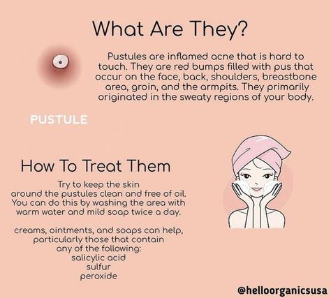 Pustules Acne, Diy Acne, Feminine Health, Acne Causes, Basic Skin Care Routine, Perfect Skin Care Routine, Acne Remedies, Healthy Skin Care, Face Skin Care