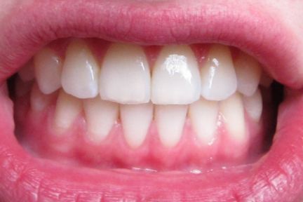 Say Braces!: Before and After Braces—Braces Off, Underbite Fixed ... Teeth After Braces, Before And After Braces, Braces Before And After, Smile Tips, Mouth Anatomy, After Braces, Adult Braces, Braces Off, Beautiful Teeth