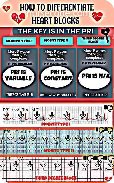 How to Differentiate Heart Blocks #nursingstudent #nurse #resources - Image Credits: Marian cezair Telemetry Nursing, Paramedic School, Nursing Information, Nursing Cheat, Nursing Mnemonics, Cardiac Nursing, Nursing School Survival, Heart Blocks, Critical Care Nursing