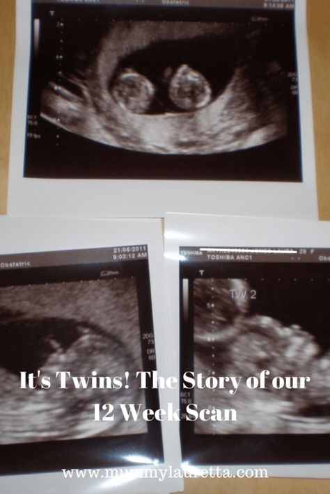 It's Twins! The Story of our 12 Week Scan - Mummy Lauretta - Twins Five Weeks Pregnant, 12 Week Ultrasound, Twins Ultrasound, Constant Nausea, 12 Week Scan, 12 Weeks Pregnant, Pregnancy Ultrasound, Infant Loss Awareness, Twin Pregnancy