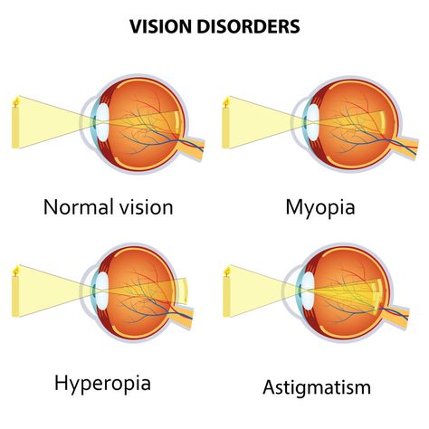 Pathology – Special Senses Pathology - MBLEx Guide Eye Disorders Nursing, Astigmatism Vision, Hyperopia Vision, Astigmatism Eye, Optician Training, Eye Defects, Lasik Eye Surgery, Eye Facts, Eye Anatomy