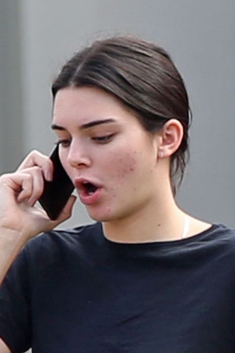 Kendall Jenner No Makeup, Kendall Jenner Mirror, Kendall Jenner Acne, Girl With Acne, Acne Positivity, Kendall Jenner Icons, Kendall Jenner Makeup, Home Remedies For Pimples, Celebs Without Makeup