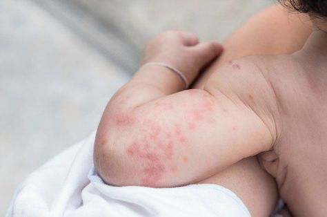 Are you uncertain about your baby's persistent rashes? Here's how to tell if it's no cause for worry or if you need to see your baby's pediatrician immediately Healthy Diet For Kids, Baby Rashes, Baby Skin Rash, Baby Food Allergies, Baby Acne, Skin And Hair Clinic, Heat Rash, Healthy Baby Food, Allergy Symptoms