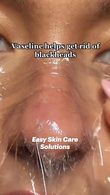 #RemediesToGetRidOfACold Easy Skin Care, Back Acne Remedies, Blind Pimple, Acne Overnight, Cold Sores Remedies, Natural Sleep Remedies, Perfect Skin Care Routine, Get Rid Of Blackheads, Natural Cough Remedies