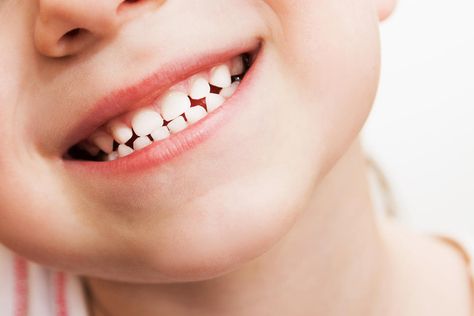 Foods That Strengthen Kids' Teeth Toothpaste Ads, Pediatric Dental Office Decor, Baby Tooth Chart, Tooth Pain Remedies, Teeth Problems, Dental Photos, Dental Bonding, Implant Dentist, Tooth Chart