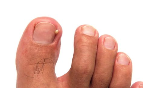 Learn about the common and bothersome issue of ingrown toenails. Learn about their causes, at-home remedies, and the crucial signs that indicate it's time to seek professional intervention. Learn everything you need to know about Ingrown toenails in our article below! #IngrownToenail #FootHealth #FeetFirstClinic #TorontoHealth Toenail Pain, Toenail Problems, Divas Can Cook, Nail Problems, Ingrown Toenail, Nail Infection, Shaving Tips, Ingrown Nail, How To Grow Nails