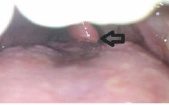 @JuniperPublishers Odynophagia after Upper Endoscopy: Uvular Necrosis authored by Runa D Watkins in #JuniperPublishers | #JournalofCasestudies Case Report An 8 year old female with DM1 and Celiac Disease underwent an esophagogastroduodenoscopy (EGD) to follow up for mucosal healing on a gluten free diet and presented with throat pain after the procedure. Throat Pain, Throat Spray, Peer Review, Abdominal Pain, Sore Throat, Medical Science, Gluten Free Diet, Pediatrics, The Professional