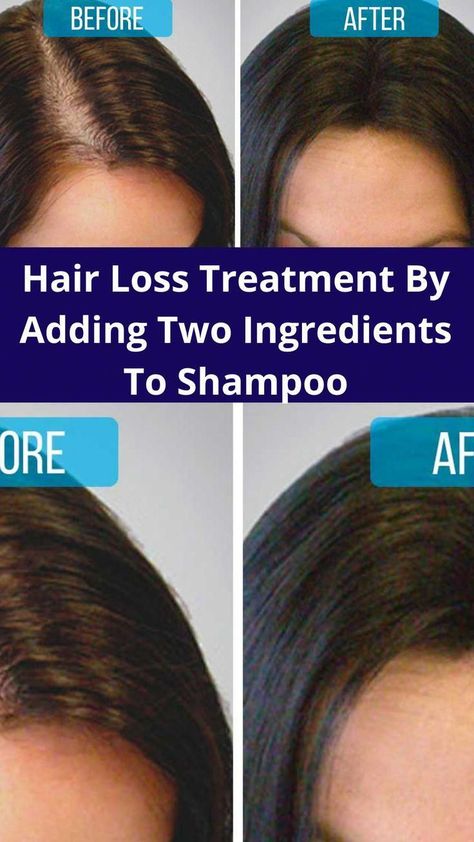 better hair Home Remedies For Hair Growth, Remedies For Hair Growth, Hair Shedding Remedies, Natural Hair Growth Remedies, Shampoo For Thinning Hair, Hair Growing Tips, Home Remedies For Hair, Hair Control, Lost Hair