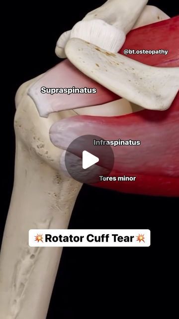 Rotator Cuff Anatomy, Torn Rotator Cuff Relief, Torn Rotator Cuff Symptoms, Rotator Cuff Pain, Traps Muscle, Rotator Cuff Surgery, Muscle Tear, Rotator Cuff Tear, Rotator Cuff Injury