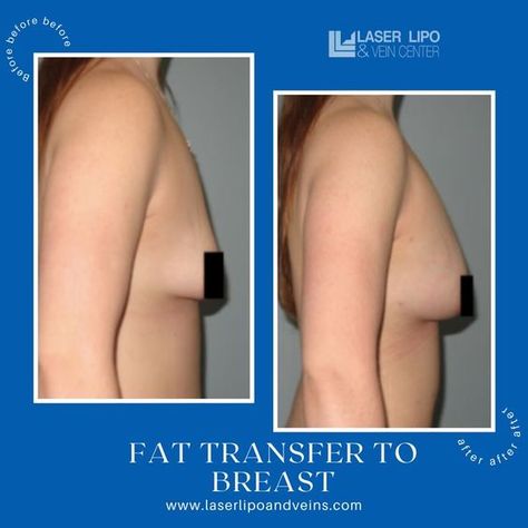 Fat Transfer To Breast, Breast Implant Sizes, Increase Breast Size, Laser Lipo, Fat Transfer, Most Asked Questions, Cosmetic Procedures, Breast Augmentation, Before And After Pictures