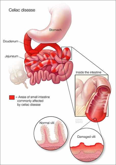 Mayo Clinic Q and A: Following Gluten-Free Diet for Celiac Disease – Mayo Clinic News Network Gluten Allergy Symptoms, Gluten Symptoms, Celiac Diagnosis, Celiacs Disease, Gluten Free Benefits, Celiac Symptoms, Fish Oil Capsules, What Is Gluten, Gut Issues