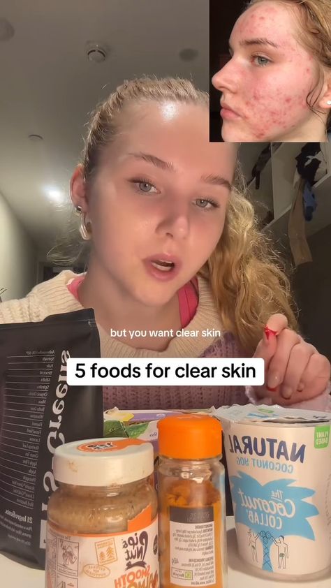 5 foods of clear skin Skin Care Whiteheads, Reasons Of Acne On Face, How To Improve Acne, Skincare Bumpy Skin, Hiding Acne With Makeup, Natural Acne Scar Remedy, Even Out Skin Tone Naturally, How Is Your Skin So Clear, How To Have Beautiful Skin