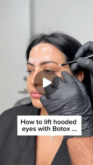 Sirak Darbinian, MD on Instagram: "How to lift hooded eyes with Botox …#botox" Botox Eye Lift Before And After, Places To Get Botox On Face, Botox Eye Lift, Botox Crows Feet Eye, Botox For Beginners, Botox For Hooded Eyes, Traptox Before And After, Botox Around Eyes, Brow Lift Botox Eyebrows