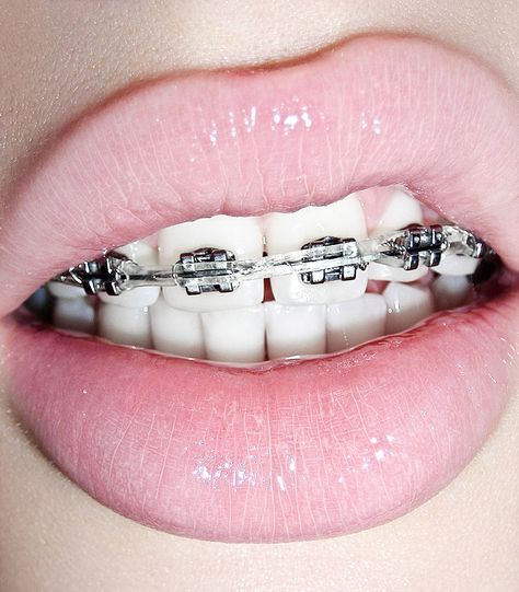 braces | Flickr - Photo Sharing! Pink Braces, Getting Braces, Cute Braces, Brace Face, Braces Colors, Orange Lips, Nice Lips, Pink Things, I Love Pink