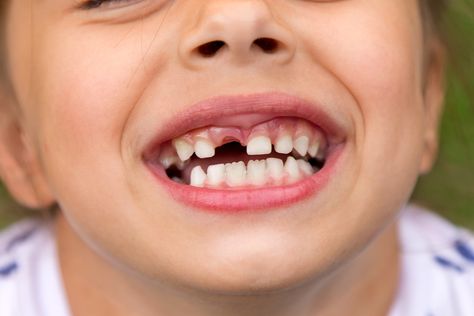 A child's missing teeth can be adorable, but if the teeth are lost prematurely it could lead to other complications. Read more in our latest blog! Childrens Dental Health, Smile Illustration, Dental Images, Teeth Art, Kids Teeth, Dental Emergency, Dental Kids, Emergency Dentist, Tooth Pain